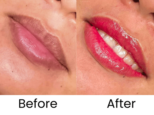 lips-before-after