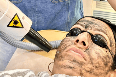 carbon-facial