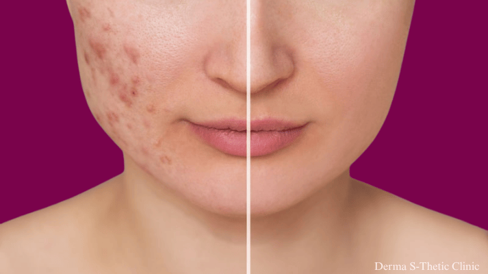 laser-hair-removal treatment