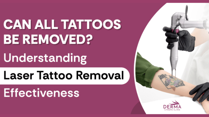 laser-hair-removal treatment